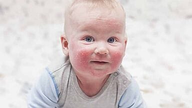 allergie nei bambini