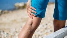 Le vene varicose, cosa sono e come combatterle a tavola Le vene varicose, cosa sono e come combatterle a tavola