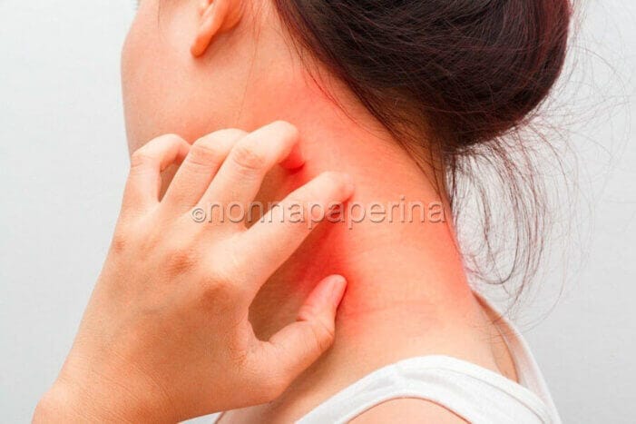 dermatite e disidrosi dermatite e disidrosi