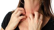 Disidrosi e intolleranza al Nichel stretta correlazione Disidrosi e intolleranza al Nichel stretta correlazione