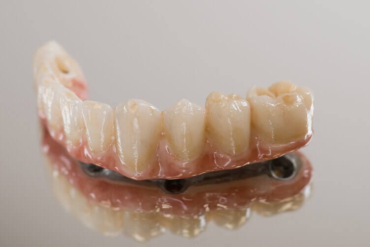 impianto dentale impianto dentale